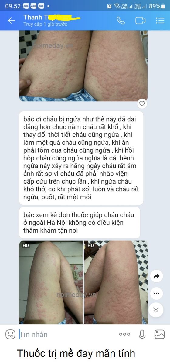 Nổi mề đay mãn tính